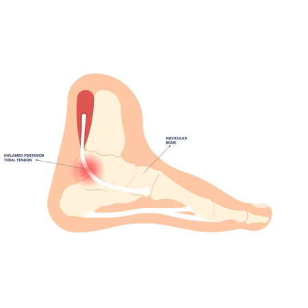 Tibialis posterior tendinopathie pijn aan binnekant voet podoloog dries de roover