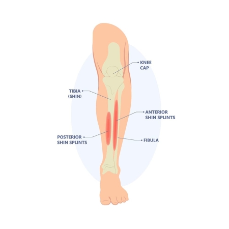 scheenbeenvliesontsteking MTSS shin splints pijn aan de binnekant scheenbeen podoloog dries de roover 1